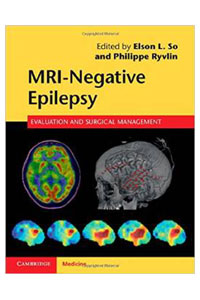 copertina di MRI ( Magnetic Resonance Imaging ) Negative Epilepsy - Evaluation and Surgical Management