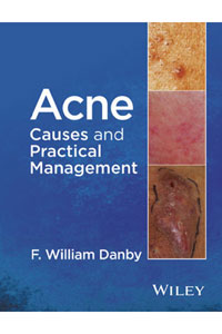 copertina di Acne: Causes and Practical Management