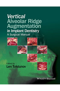 copertina di Vertical Augmentation of the Alveolar Ridge in Implant Dentistry