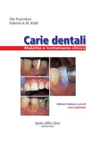 copertina di Carie dentali - Malattia e trattamento clinico
