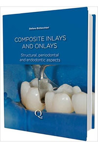 copertina di Composite inlays and onlays