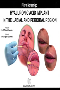 copertina di Hyaluronic acid implant in the labial and perioral region