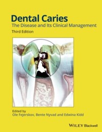 copertina di Dental Caries - The Disease and Its Clinical Management