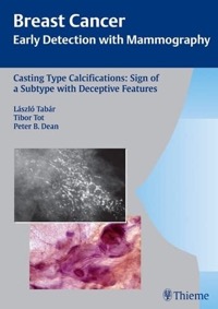 copertina di Breast Cancer - Early Detection with Mammography - Casting Type Calcifications : ...