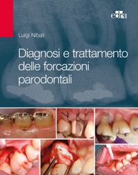 copertina di Diagnosi e trattamento delle forcazioni parodontali