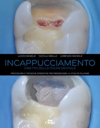 copertina di Incappucciamento diretto della polpa dentale - Procedure e tecniche operative per ...